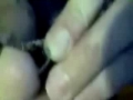 Guy rips off his dead toe nail